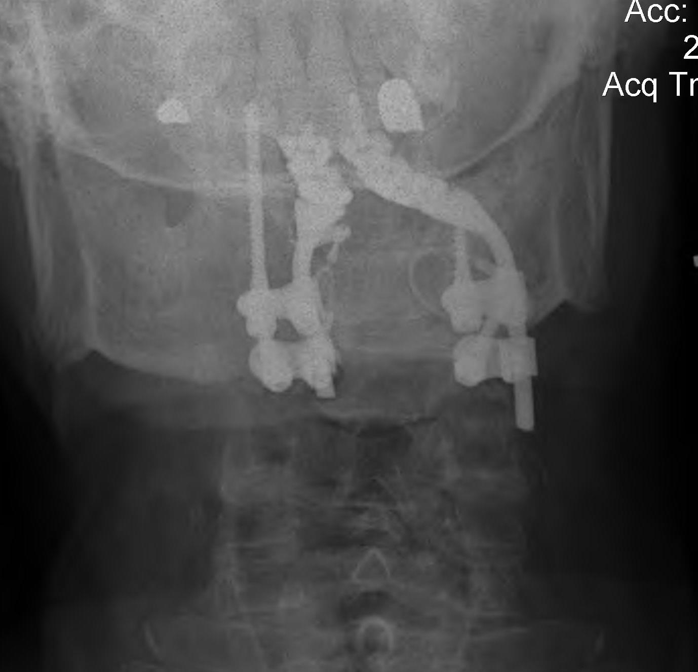 Occipito Cervical Fusion AP